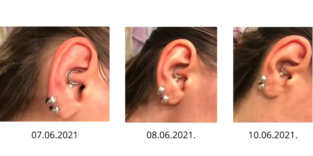 keloid na pirsingu
